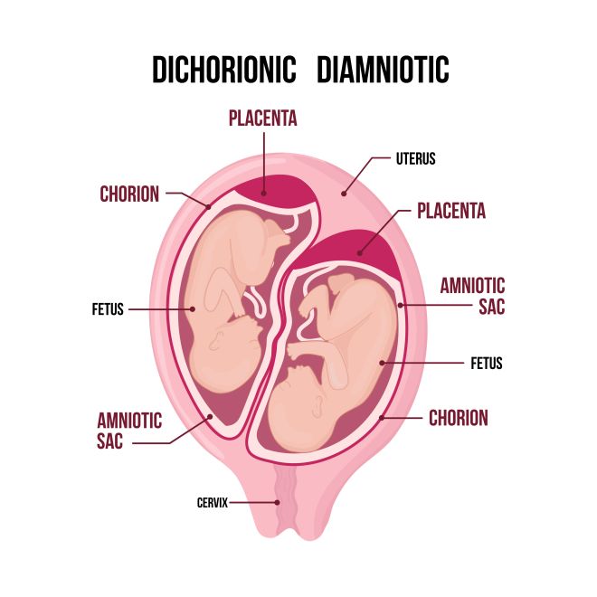 gravidanza gemellare eterozigote bicoriale e biamniotica